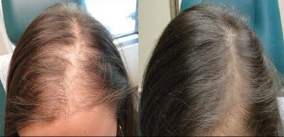 Angela C., 52 — Part line comparison after 14 weeks of overnight application.